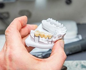 Dental bridge on a clay model