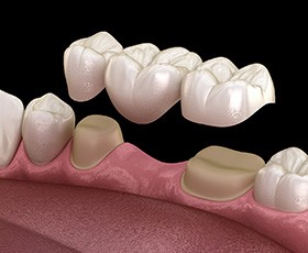 Digital illustration of a dental bridge