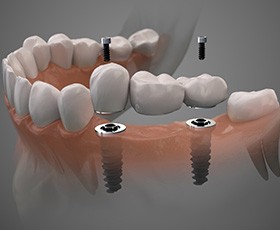 Digital illustration of an implant bridge